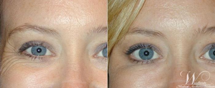 Before & After BOTOX® Cosmetic Case 20 Front View in The Woodlands, TX
