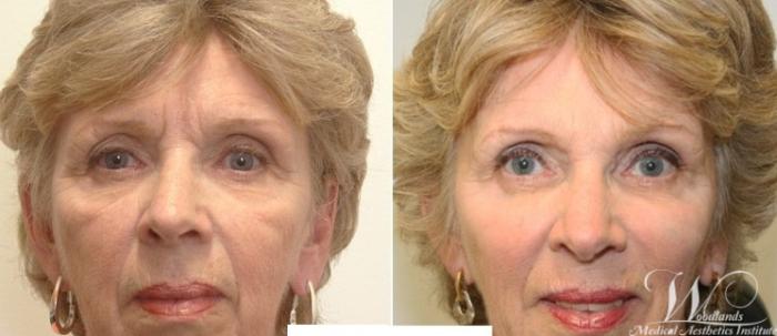 Before & After BOTOX® Cosmetic Case 21 Front View in The Woodlands, TX