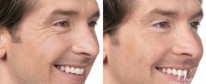 Before & After BOTOX® Cosmetic Case 22 Right Oblique View in The Woodlands, TX