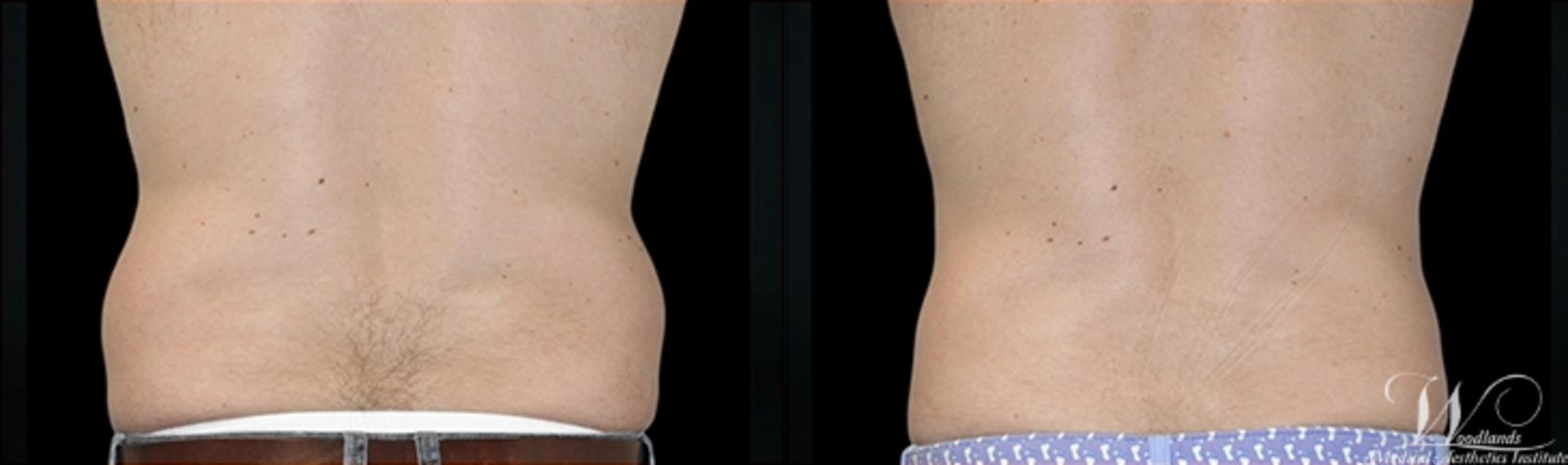 Before & After CoolSculpting® Case 1 Back View in The Woodlands, TX