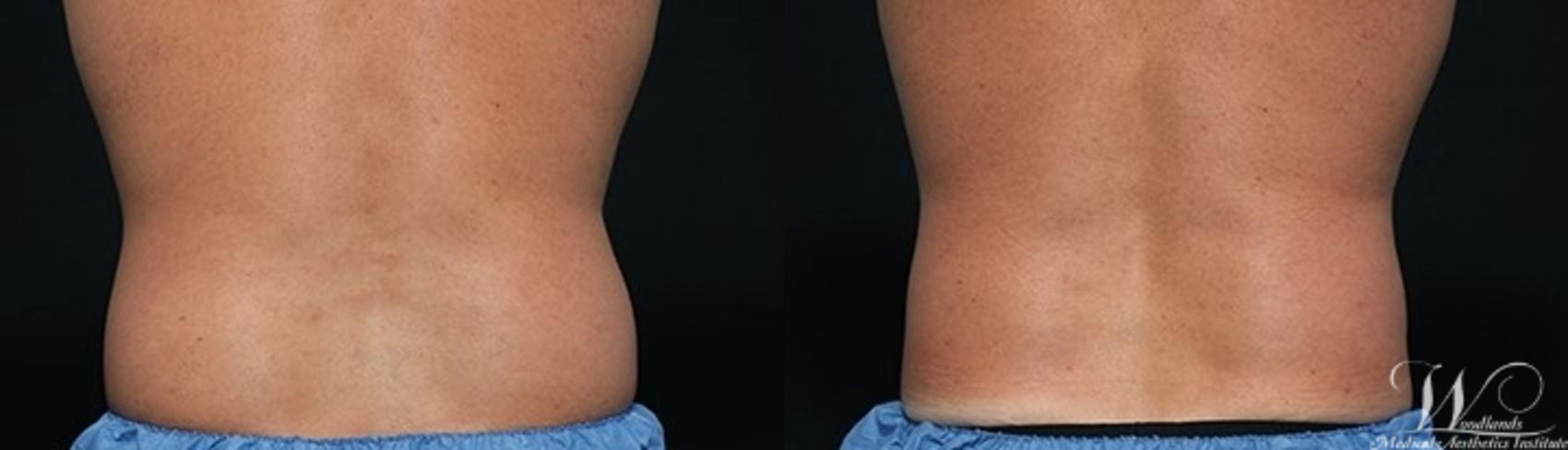Before & After CoolSculpting® Case 10 Back View in The Woodlands, TX