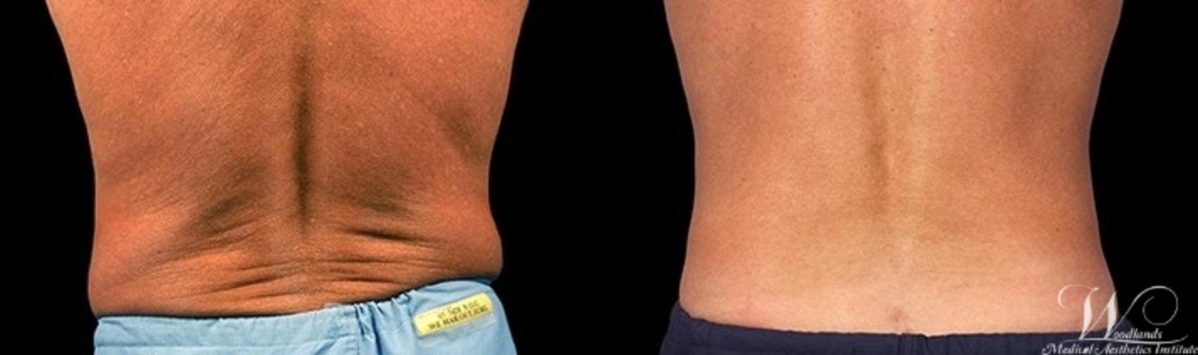 Before & After CoolSculpting® Case 11 Back View in The Woodlands, TX