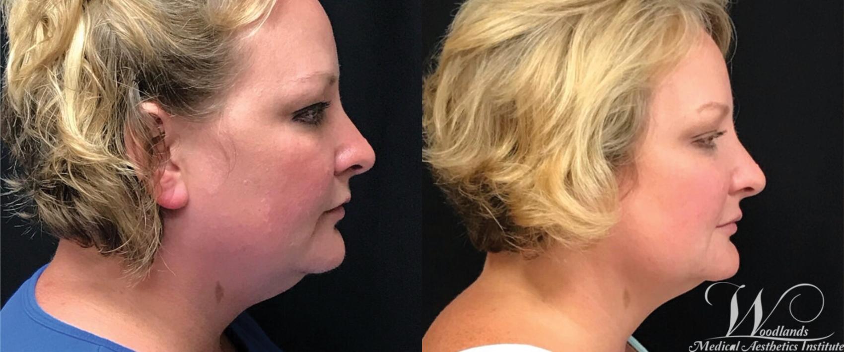 Before & After CoolSculpting® Case 2 Right Side View in The Woodlands, TX