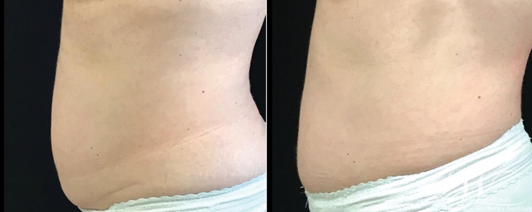 Before & After CoolSculpting® Case 3 Left Side View in The Woodlands, TX