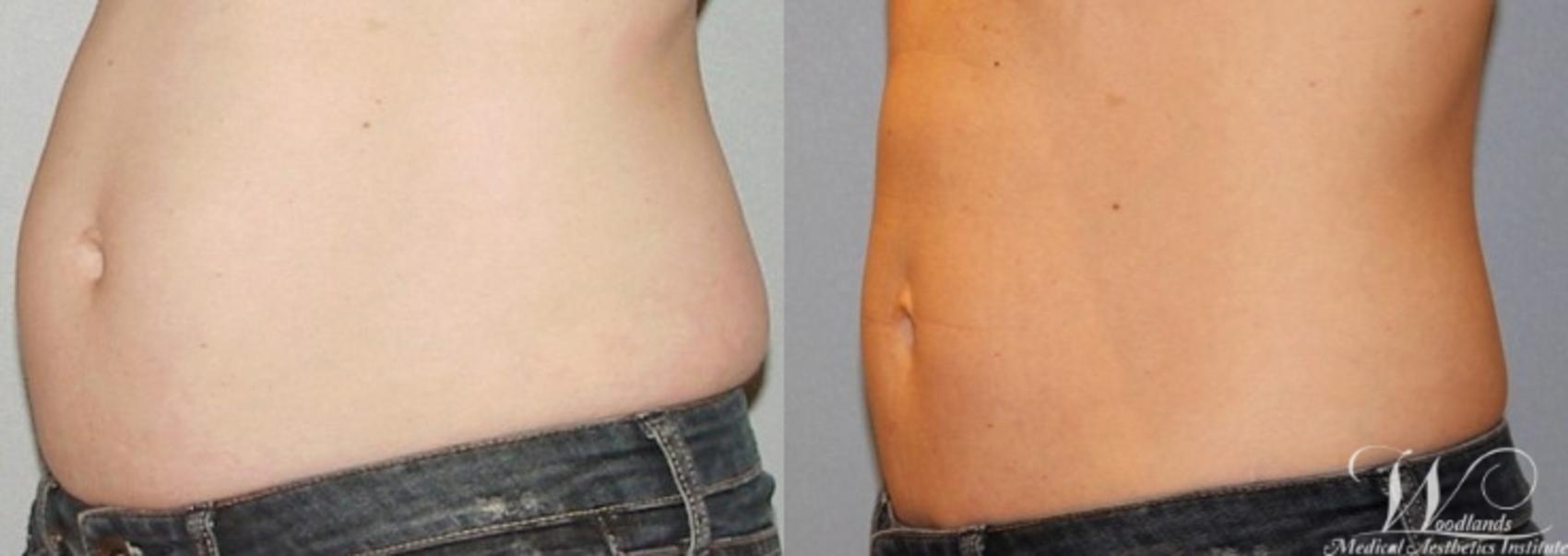 Before & After CoolSculpting® Case 4 Left Side View in The Woodlands, TX