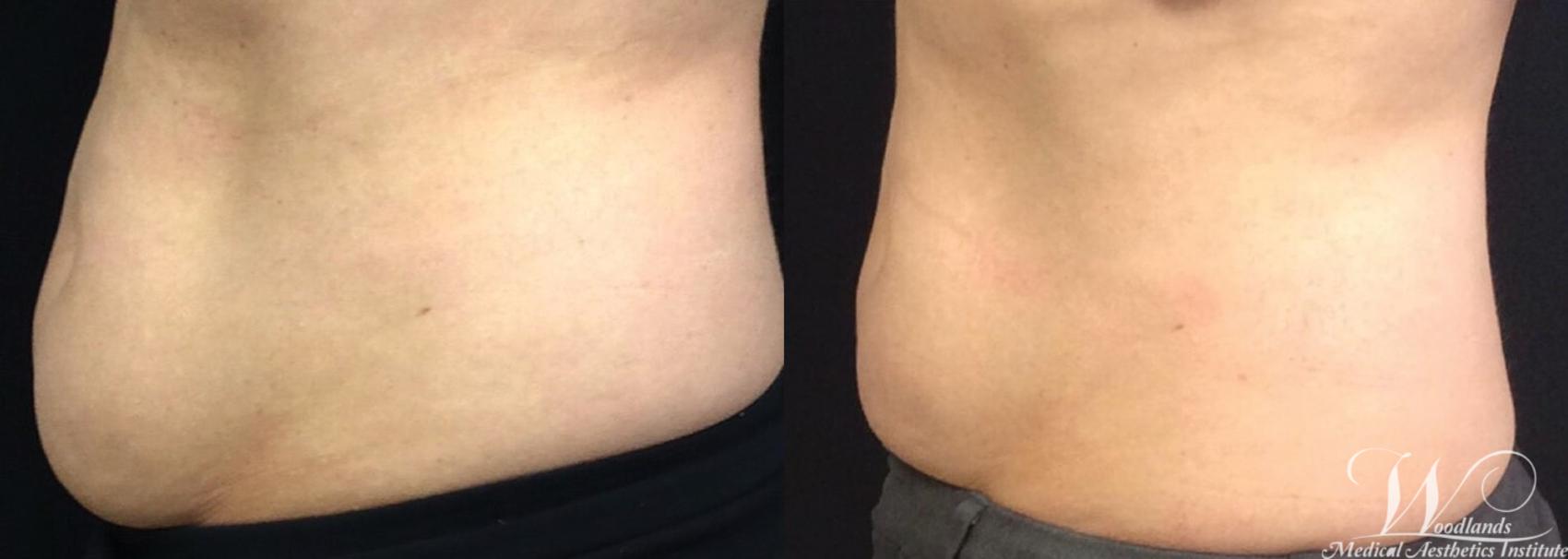 Before & After CoolSculpting® Case 5 Left Side View in The Woodlands, TX