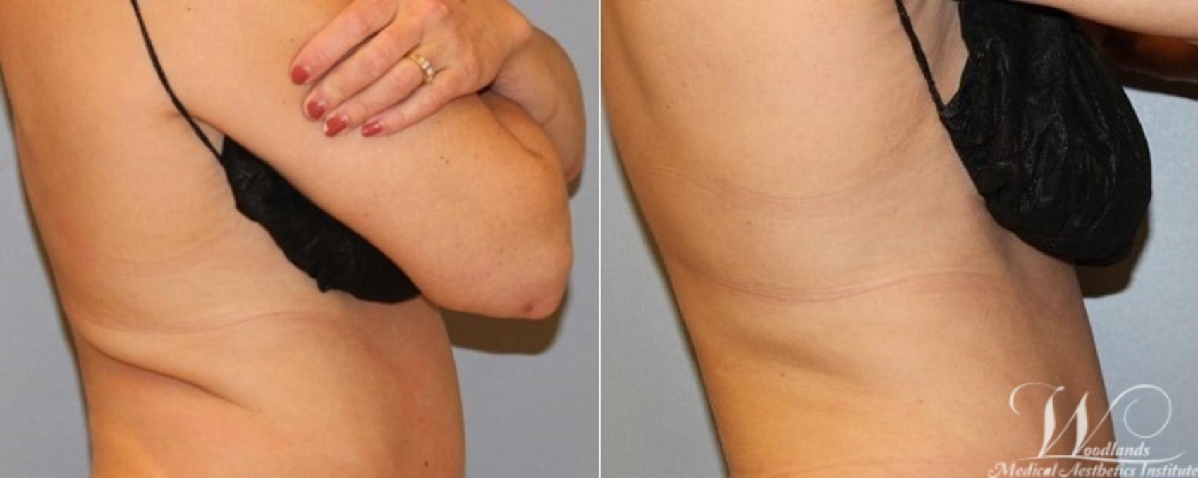 Before & After CoolSculpting® Case 6 Right Side View in The Woodlands, TX