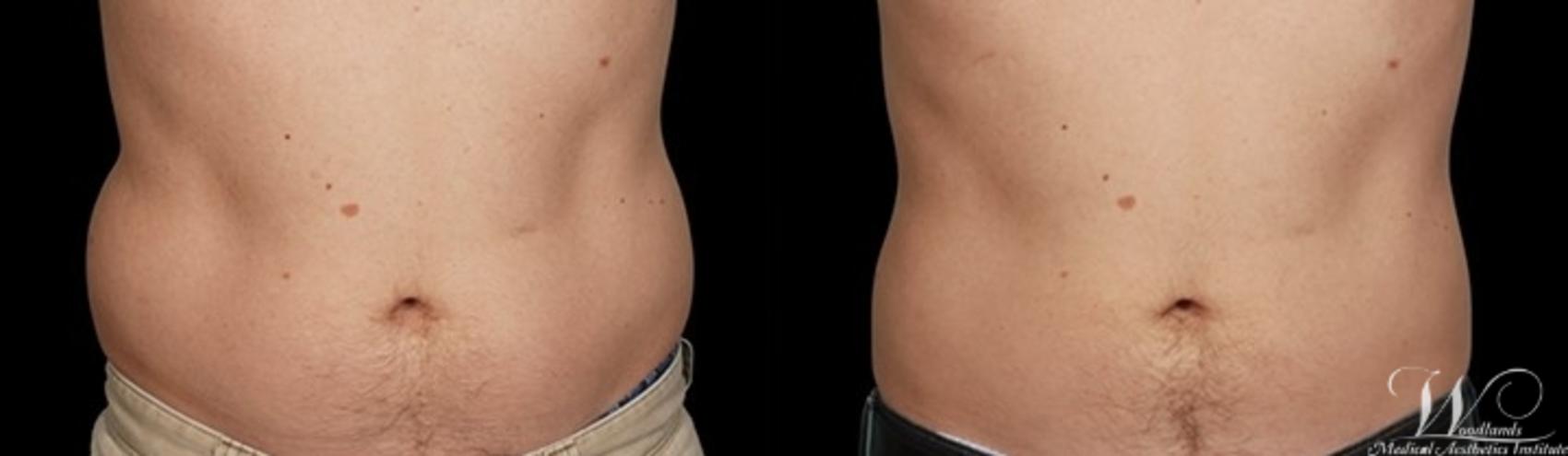 Before & After CoolSculpting® Case 7 Front View in The Woodlands, TX