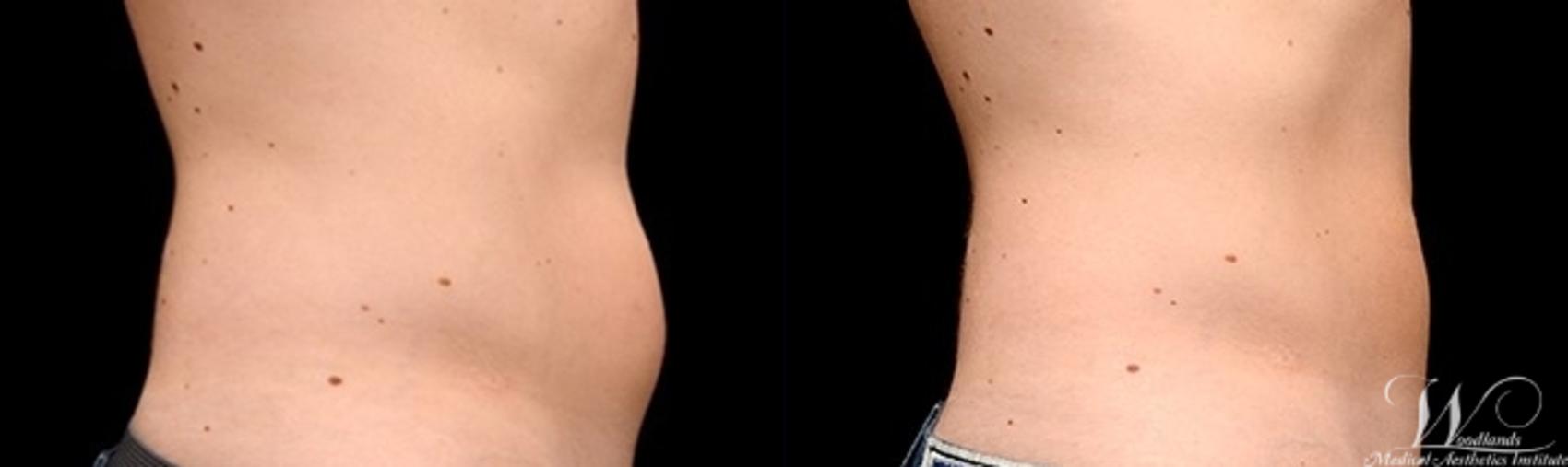 Before & After CoolSculpting® Case 9 Right Side View in The Woodlands, TX