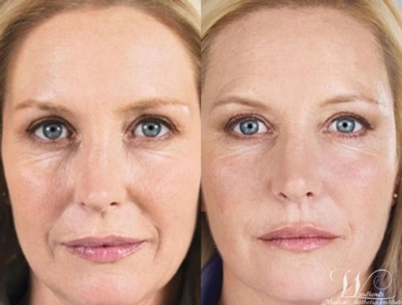 Before & After Dermal Fillers Case 28 Front View in The Woodlands, TX