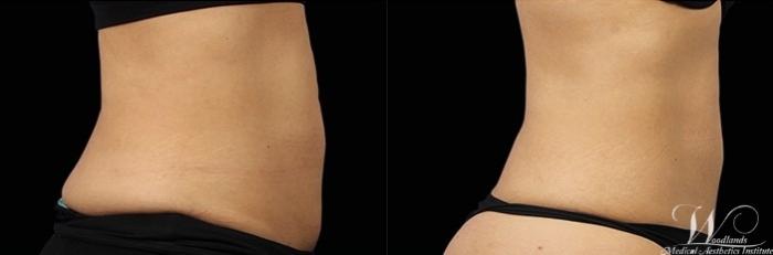 Before & After EMSCULPT® Case 12 Right Side View in The Woodlands, TX