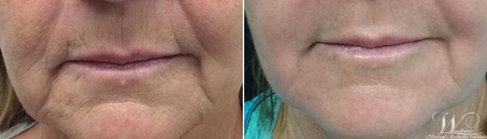 Before & After Halo™ Laser Skin Resurfacing Case 40 Front View in The Woodlands, TX