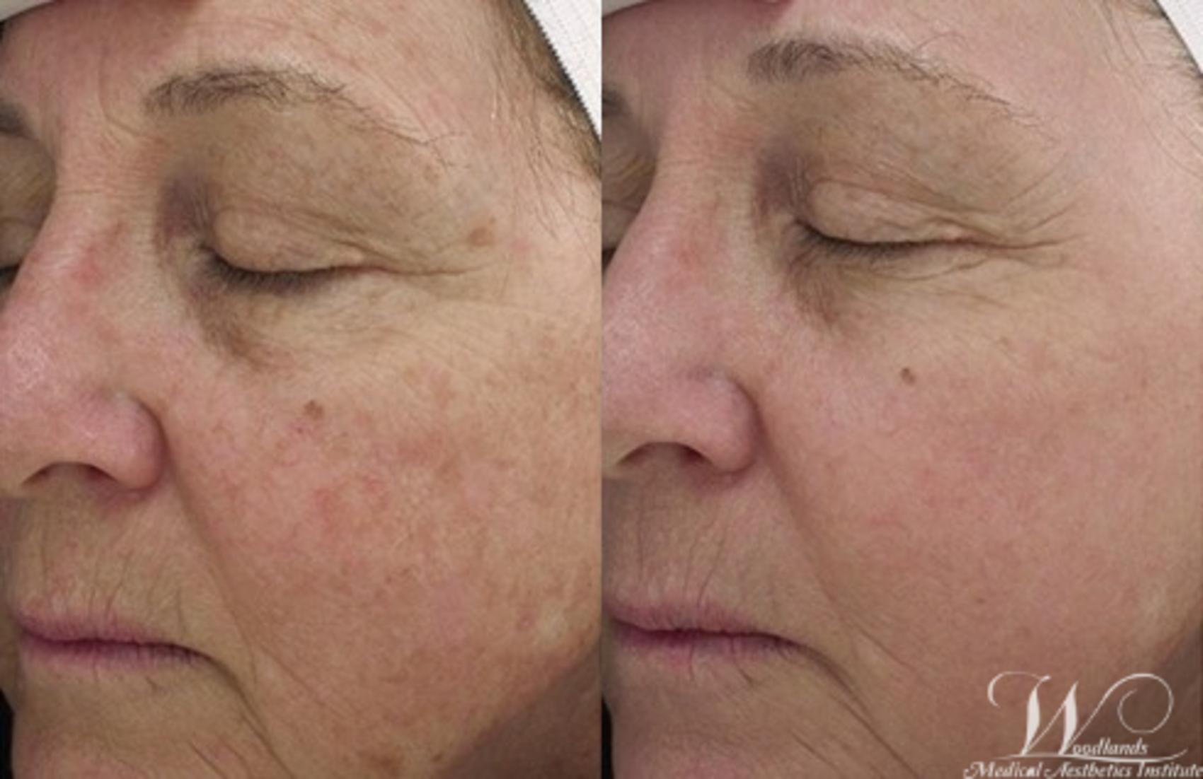 Before & After Halo™ Laser Skin Resurfacing Case 41 Left Oblique View in The Woodlands, TX