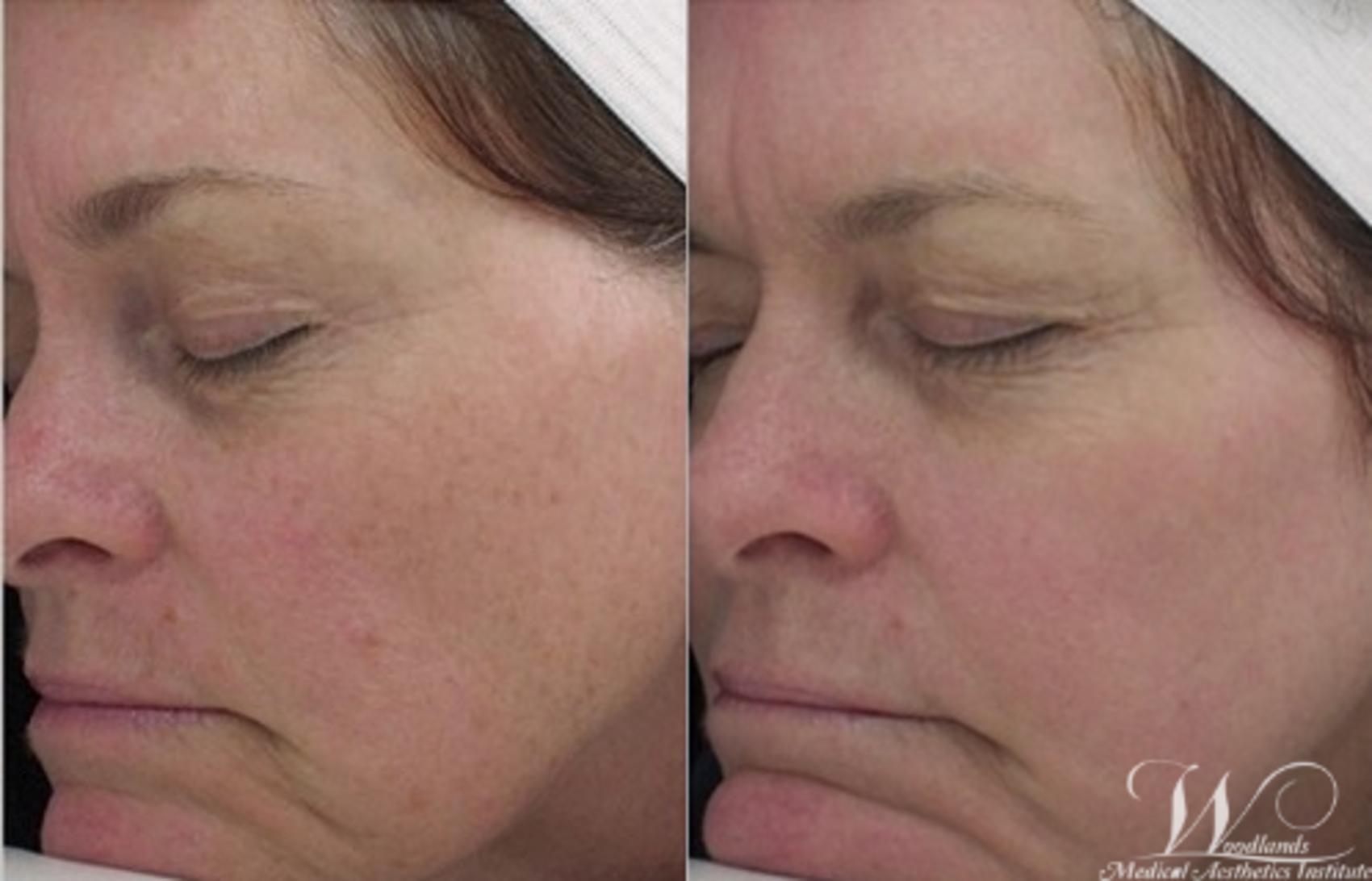 Before & After Halo™ Laser Skin Resurfacing Case 42 Left Oblique View in The Woodlands, TX