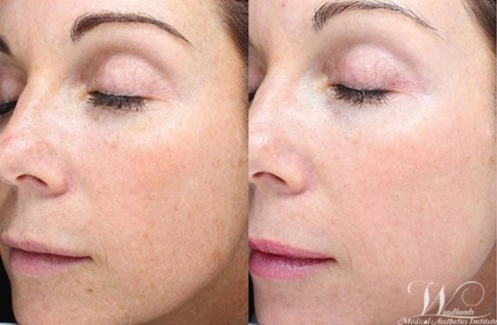 Before & After Halo™ Laser Skin Resurfacing Case 43 Left Oblique View in The Woodlands, TX