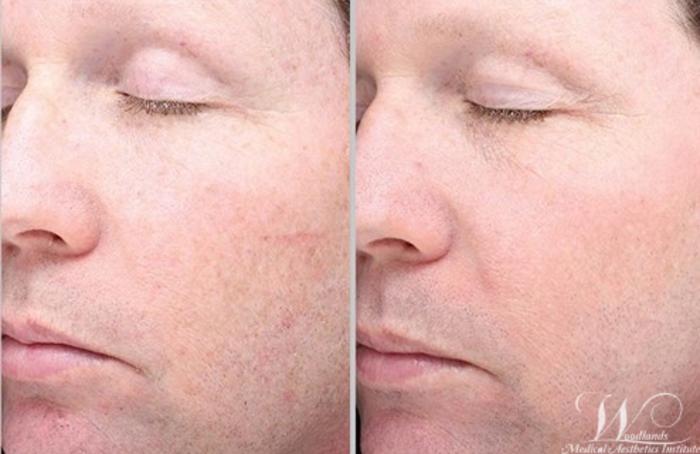Before & After Halo™ Laser Skin Resurfacing Case 44 Left Oblique View in The Woodlands, TX
