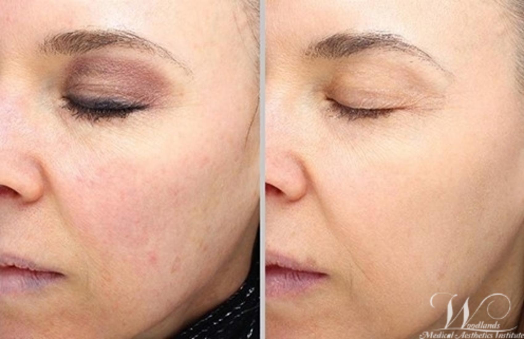 Before & After Halo™ Laser Skin Resurfacing Case 45 Left Oblique View in The Woodlands, TX
