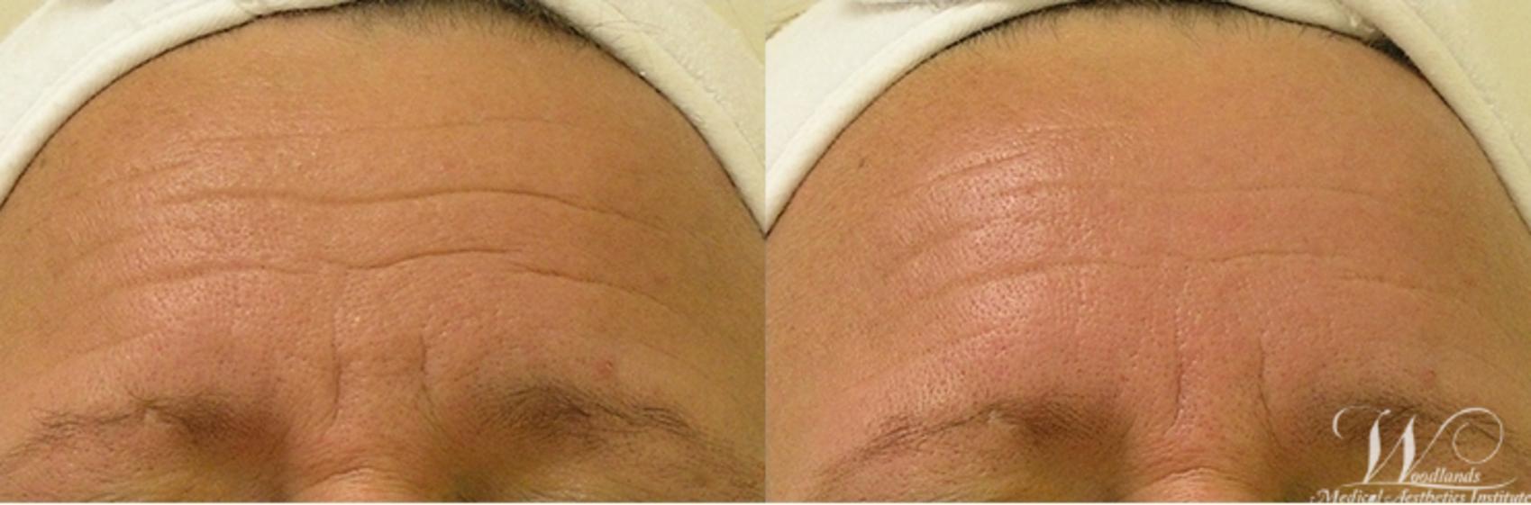 Before & After HydraFacial MD® Case 52 View 1 View in The Woodlands, TX