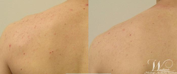 Before & After HydraFacial MD® Case 53 View 1 View in The Woodlands, TX