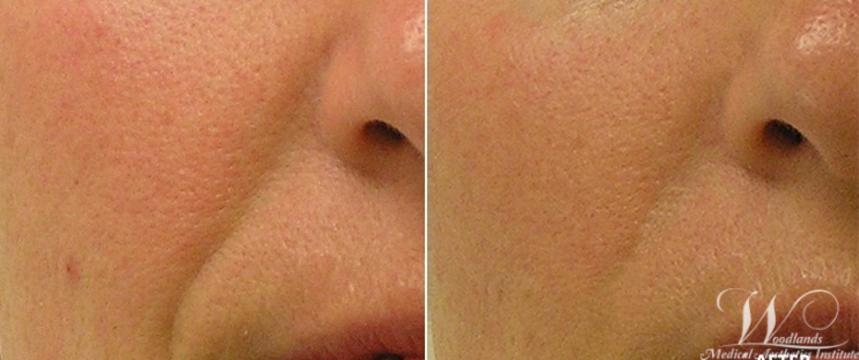 Before & After HydraFacial MD® Case 55 View 1 View in The Woodlands, TX