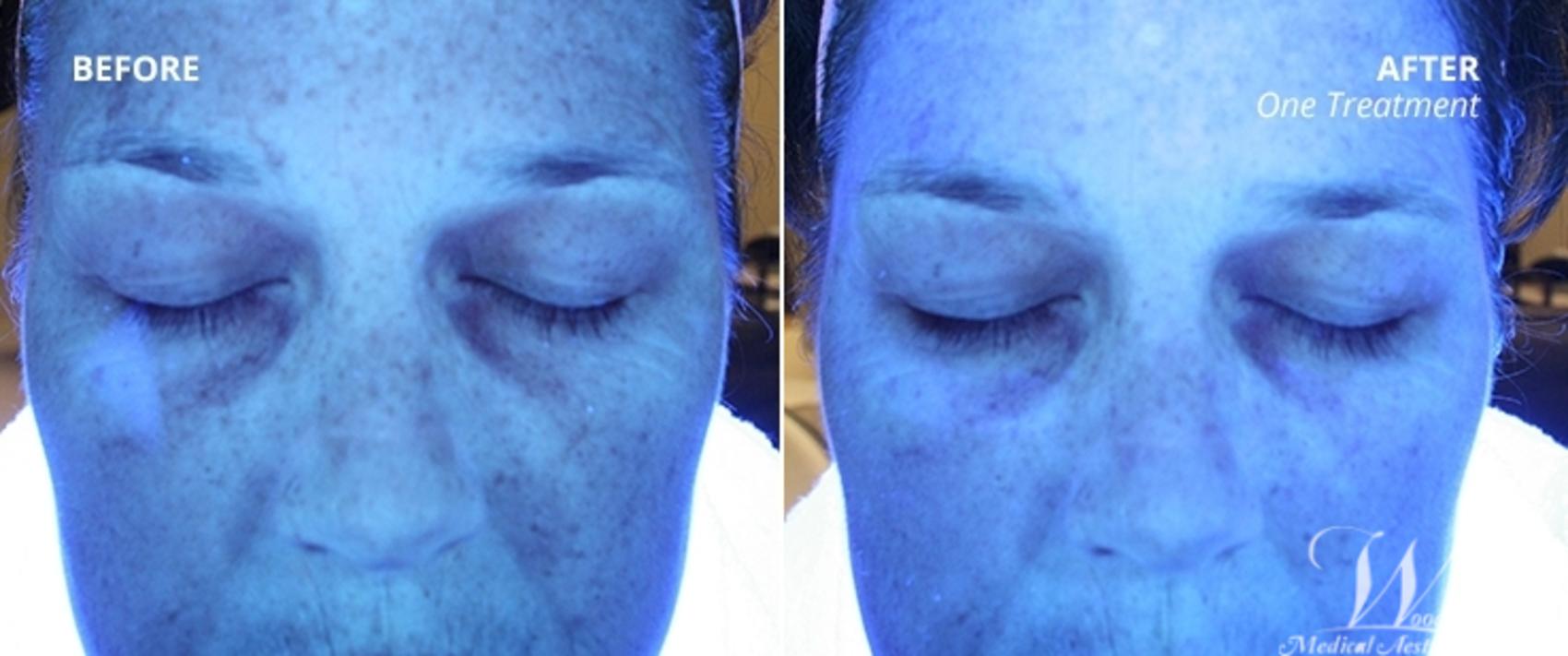 Before & After HydraFacial MD® Case 56 Front View in The Woodlands, TX