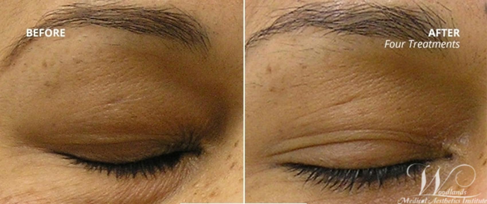 Before & After HydraFacial MD® Case 57 View 1 View in The Woodlands, TX