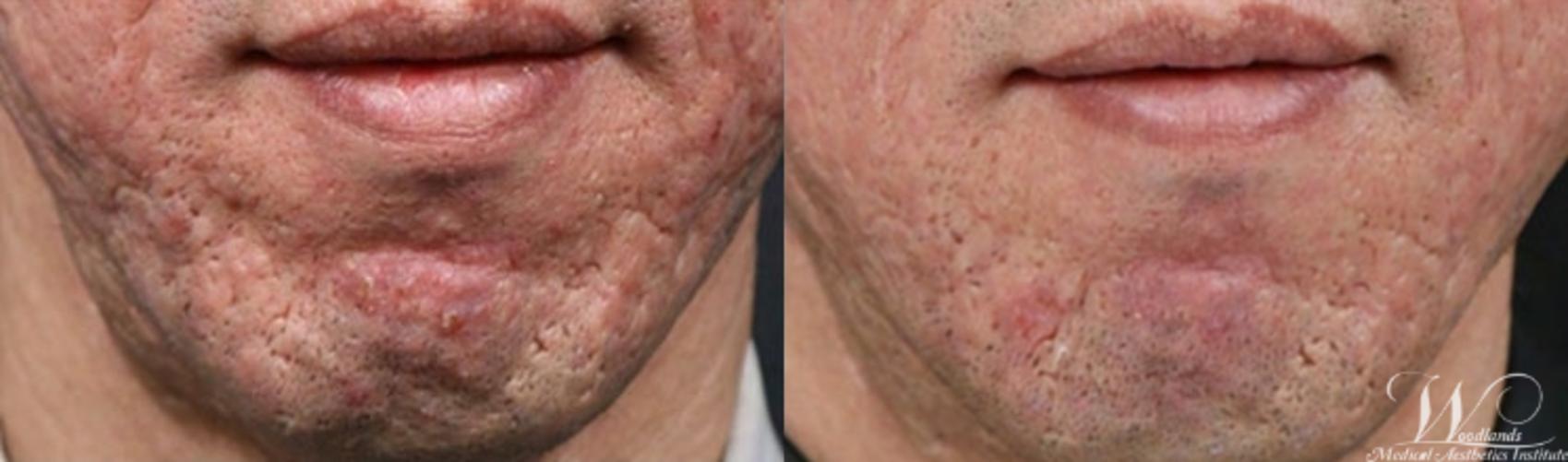Before & After RF Microneedling Case 59 View 1 View in The Woodlands, TX