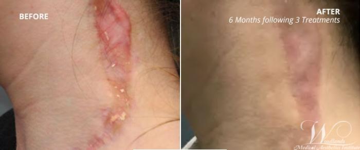 Before & After RF Microneedling Case 61 View 1 View in The Woodlands, TX