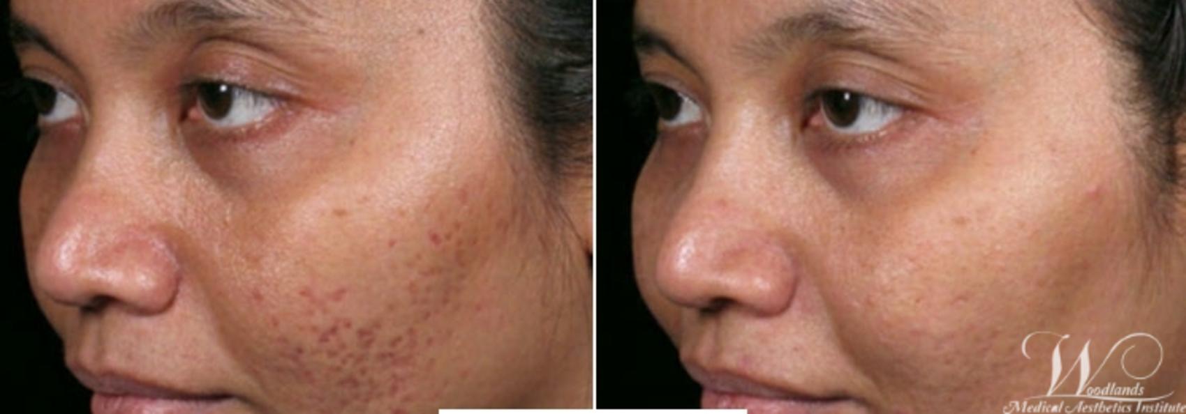 Before & After RF Microneedling Case 62 Left Oblique View in The Woodlands, TX