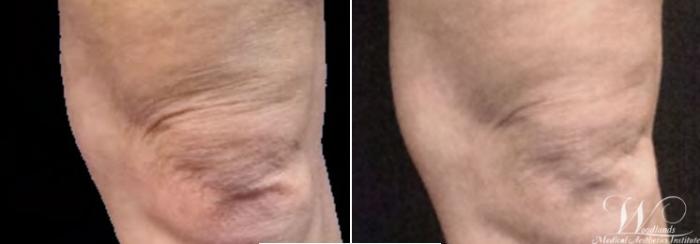 Before & After RF Microneedling Case 63 View 1 View in The Woodlands, TX