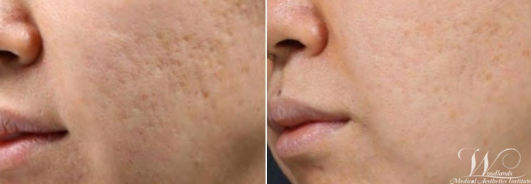 Before & After RF Microneedling Case 64 Left Oblique View in The Woodlands, TX