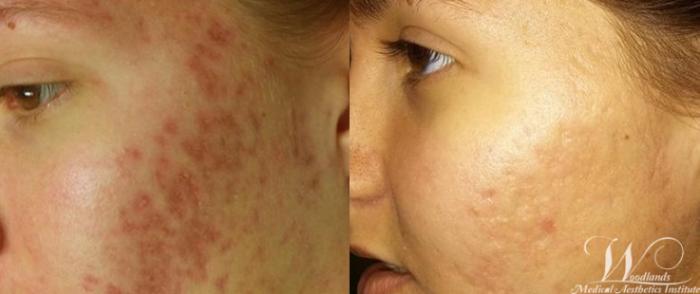 Before & After SkinPen® Microneedling Case 46 Left Side View in The Woodlands, TX