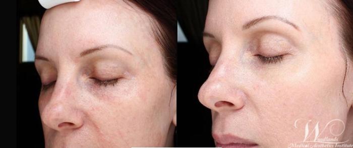 Before & After SkinPen® Microneedling Case 48 Left Oblique View in The Woodlands, TX