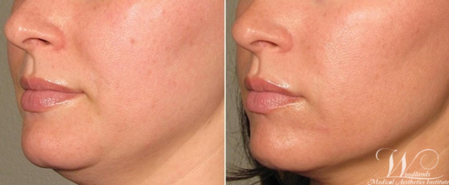 Before & After Ultherapy® Skin Tightening Case 35 Left Oblique View in The Woodlands, TX