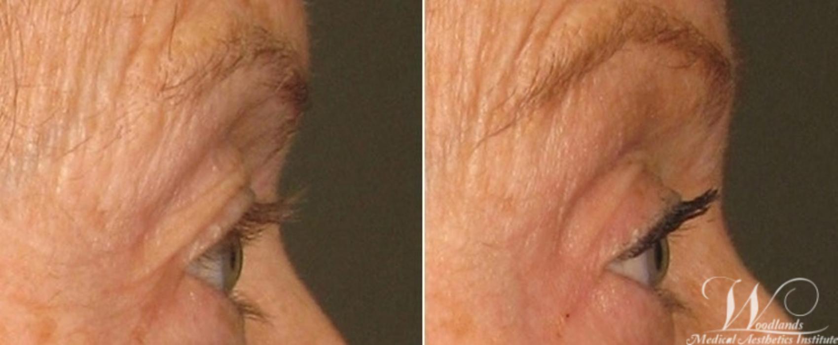 Before & After Ultherapy® Skin Tightening Case 36 Right Side View in The Woodlands, TX