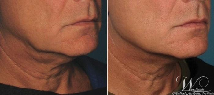Before & After Ultherapy® Skin Tightening Case 37 Right Oblique View in The Woodlands, TX