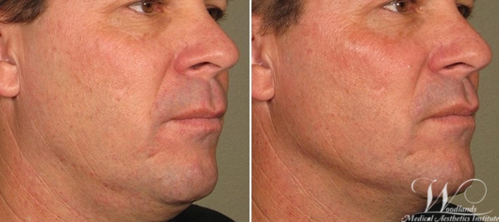 Before & After Ultherapy® Skin Tightening Case 39 Right Oblique View in The Woodlands, TX
