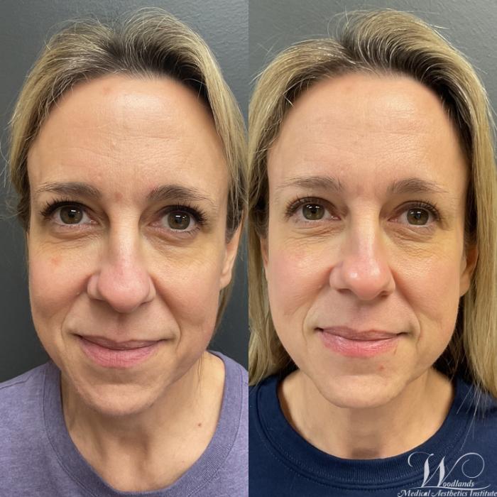 Before & After Ultherapy® Skin Tightening Case 79 Front View in The Woodlands, TX