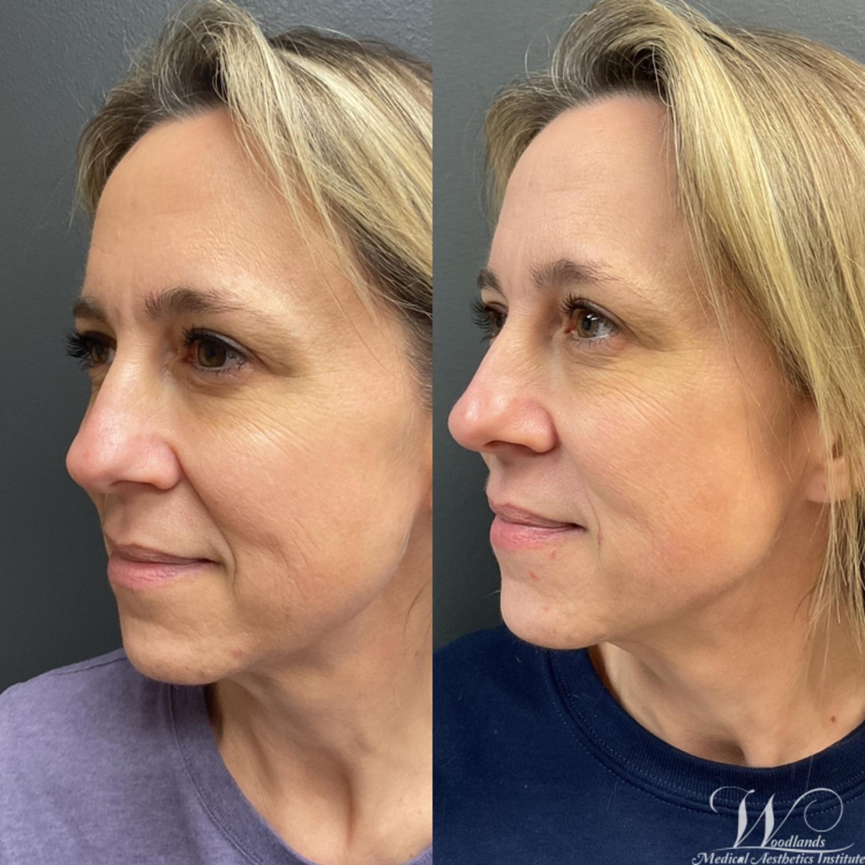 Before & After Ultherapy® Skin Tightening Case 79 Left Oblique View in The Woodlands, TX