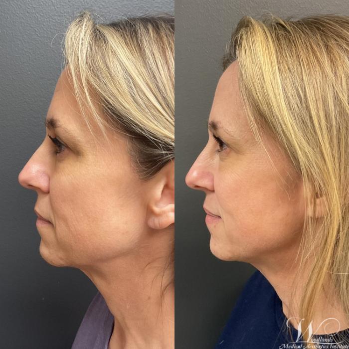 Before & After Ultherapy® Skin Tightening Case 79 Left Side View in The Woodlands, TX