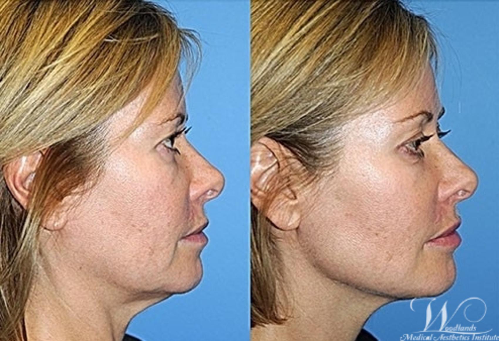 Before & After Y LIFT® Case 30 Right Side View in The Woodlands, TX